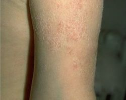 Allgemeine Dermatologie_Austrocknungsekzem.jpg