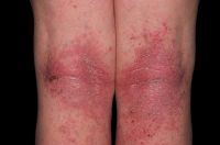 Allgemeine Dermatologie_Neurodermitis2.jpg